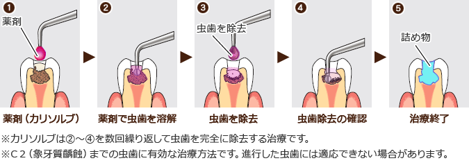 カリソルブの治療ステップ