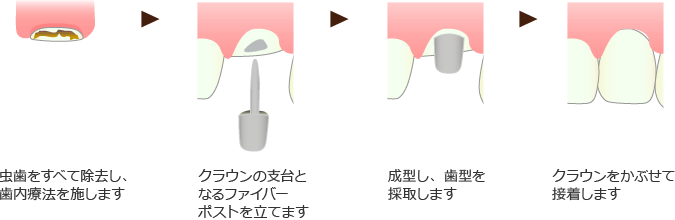 クラウン修復法の治療イメージ