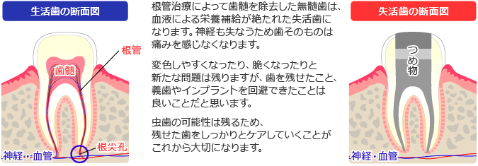 失活歯と生活歯の違い