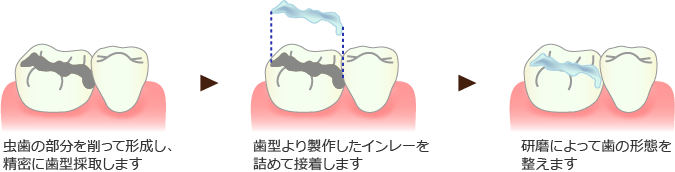 インレー修復法の治療イメージ