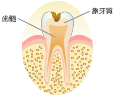 象牙質の虫歯