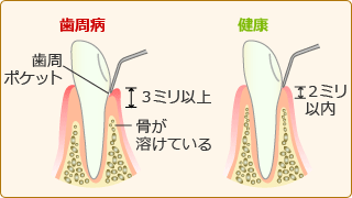 歯周ポケット深度測定