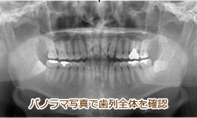 レントゲン検査