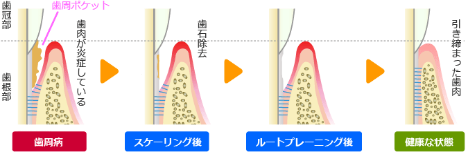 ルートプレーニング（歯根面クリーニング）