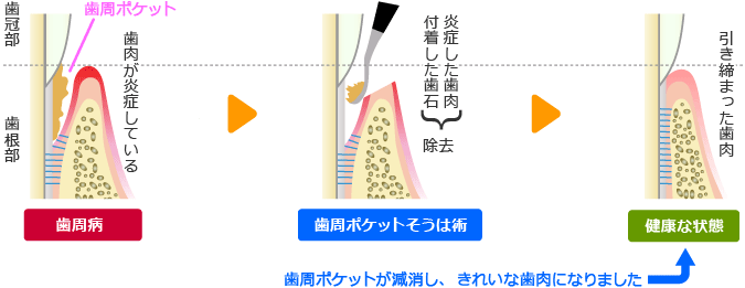 歯周ポケット掻爬(そうは)術