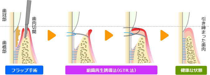 組織再生誘導法（ＧＴＲ法）