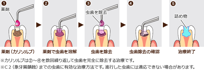 カリソルブの治療ステップ