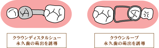 永久歯の誘導管理