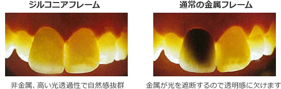 ジルコニアフレームと金属フレームの比較