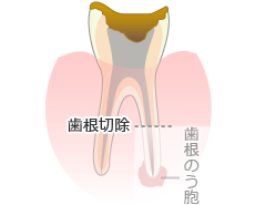 歯根端切除術