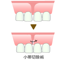 小帯切除術