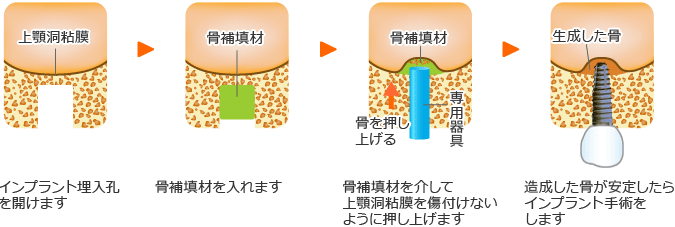 ソケットリフト法