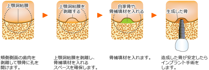 サイナスリフト法