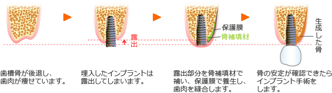 骨誘導再生療法（GBR法）