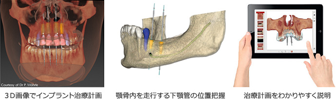 ３Ｄ画像でインプラント治療計画