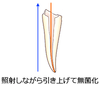 根管治療