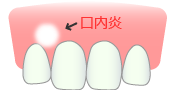 口内炎の改善