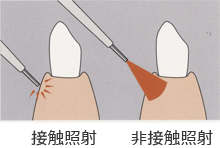 歯科レーザー治療