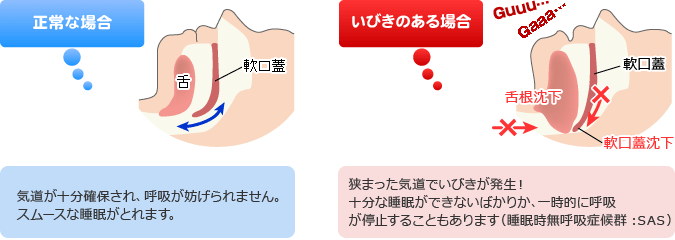 いびきのメカニズム