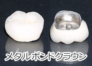 よろず屋　歯科金属　メタルボンド よろず屋様専用 歯科金属 メタルボンド