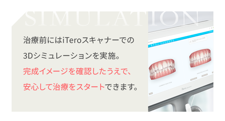 治療前にはTeroスキャナーでの3Dシミュレーションを実施。完成イメージを確認したうえで、安心して治療をスタートできます。